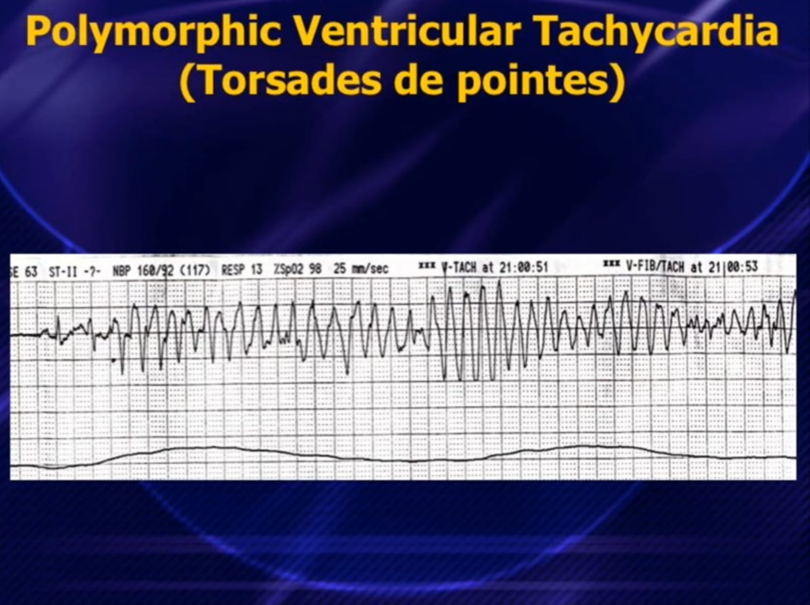 ECG – Torsades de Pointes
