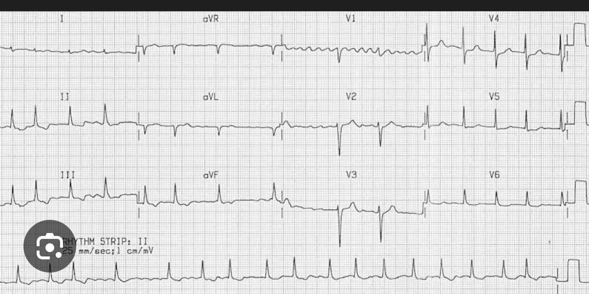 12-lead ECG – Atrial Fibrillation