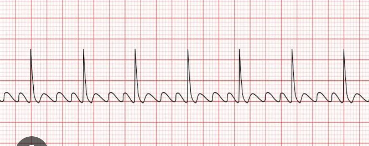 ECG strip – Atrial Flutter