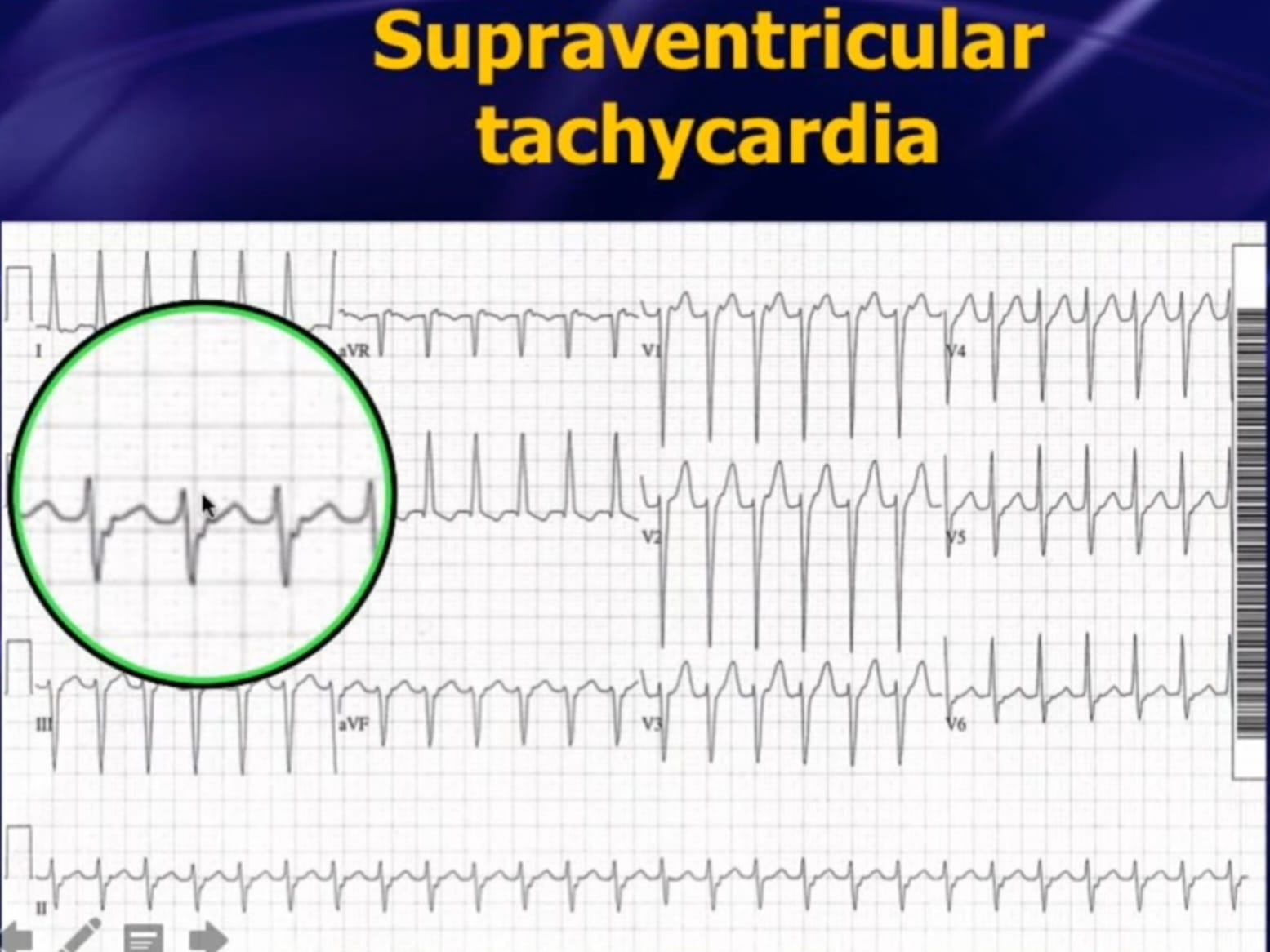 12-lead ECG – Supraventricular tachycardia