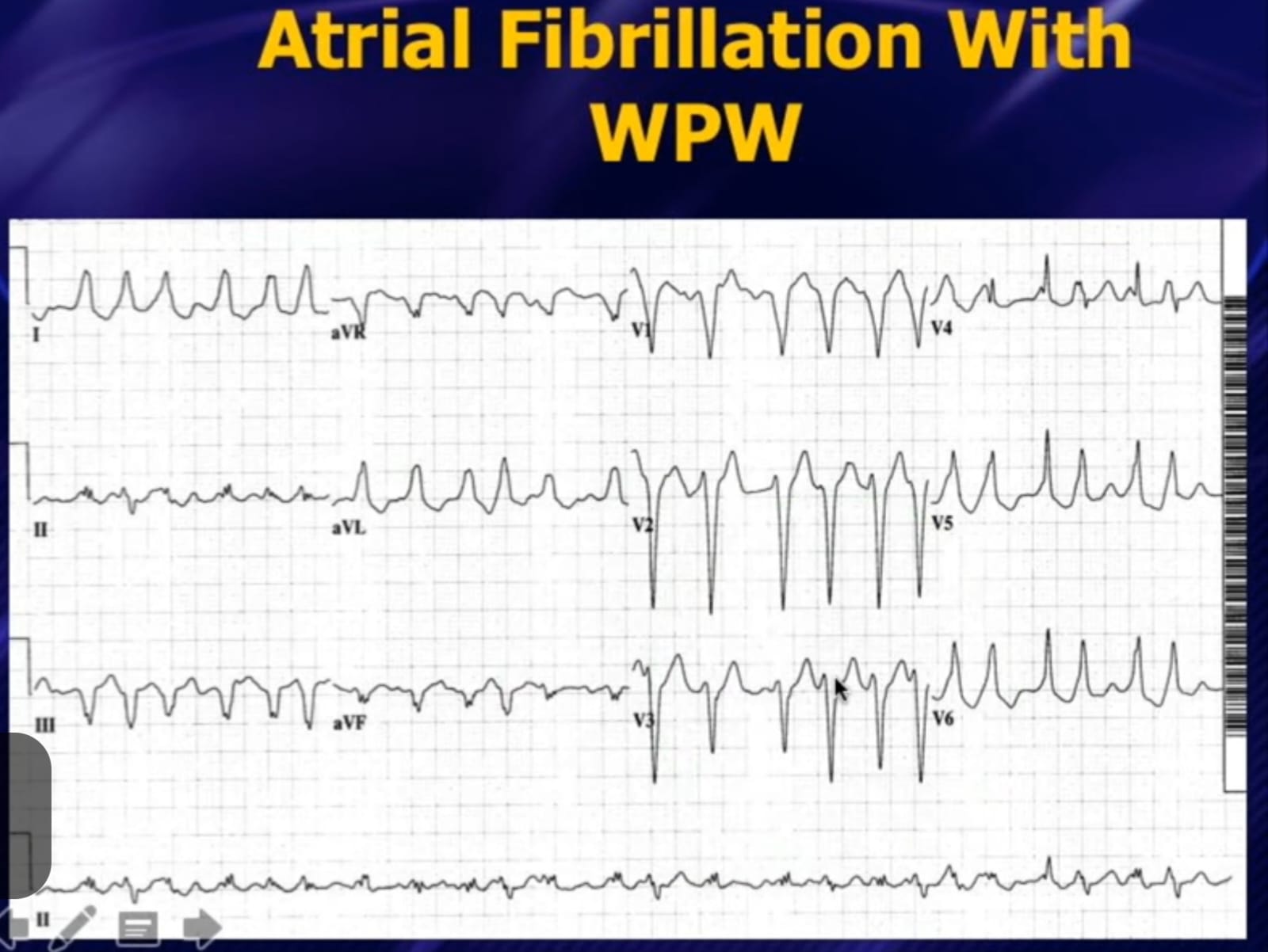 12-lead ECG – Atrial Fibrillation with WPW