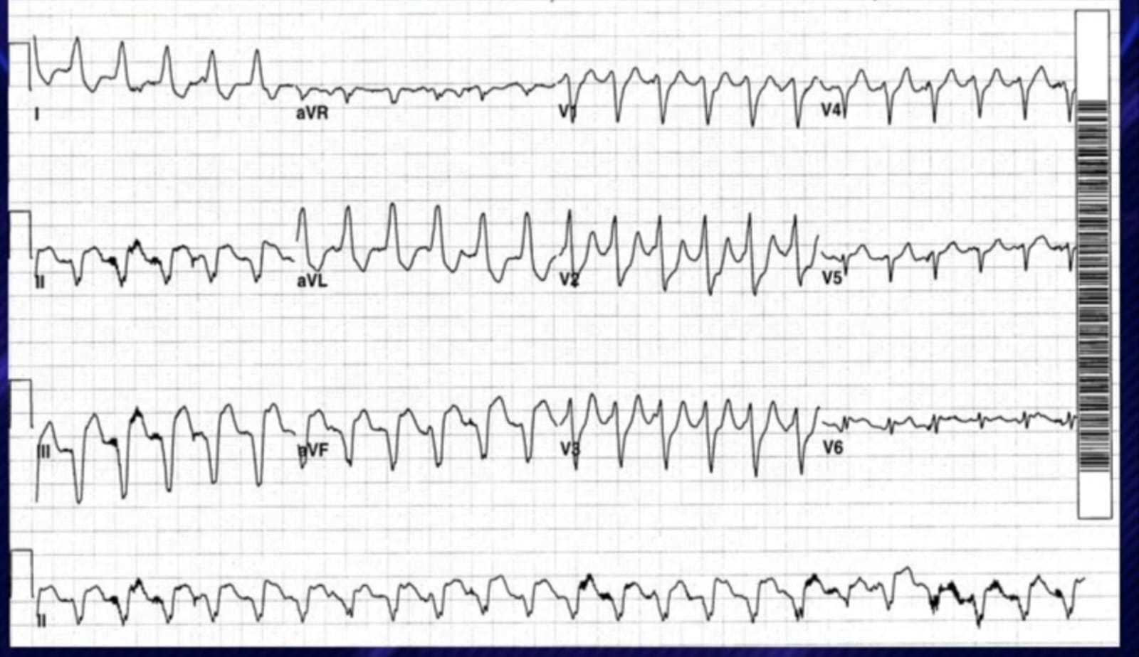 12-lead ECG – Ventricular Tachycardia