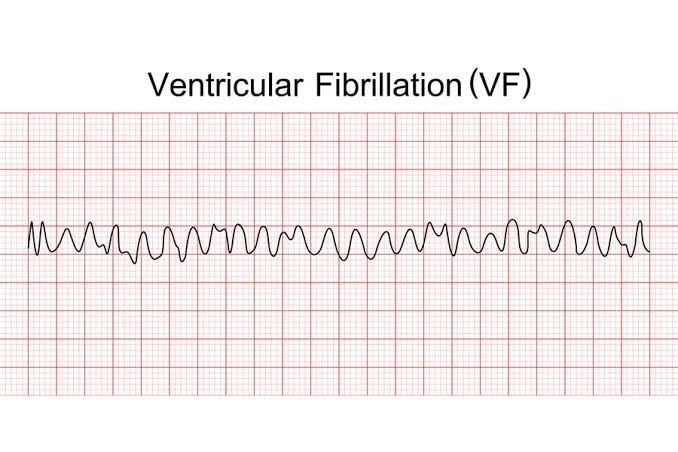 ECG – Ventricular Fibrillation